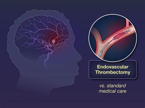 hermes marlow et al|Endovascular Thrombectomy and Outcomes in Ischemic Stroke.